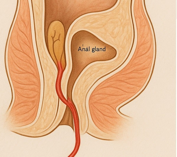 Perianal fistür Nedir? Belirtileri ve Tedavi Yöntemleri